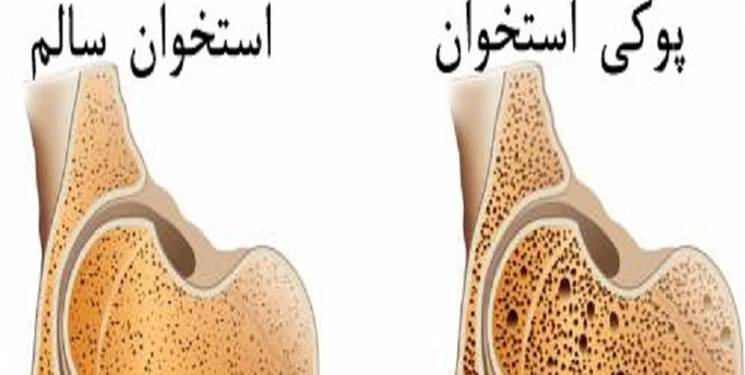 نشانه های پوکی استخوان