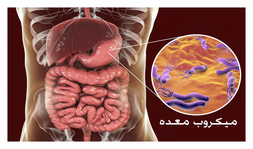 میکروب معده یا هلیکوباکترپیلوری